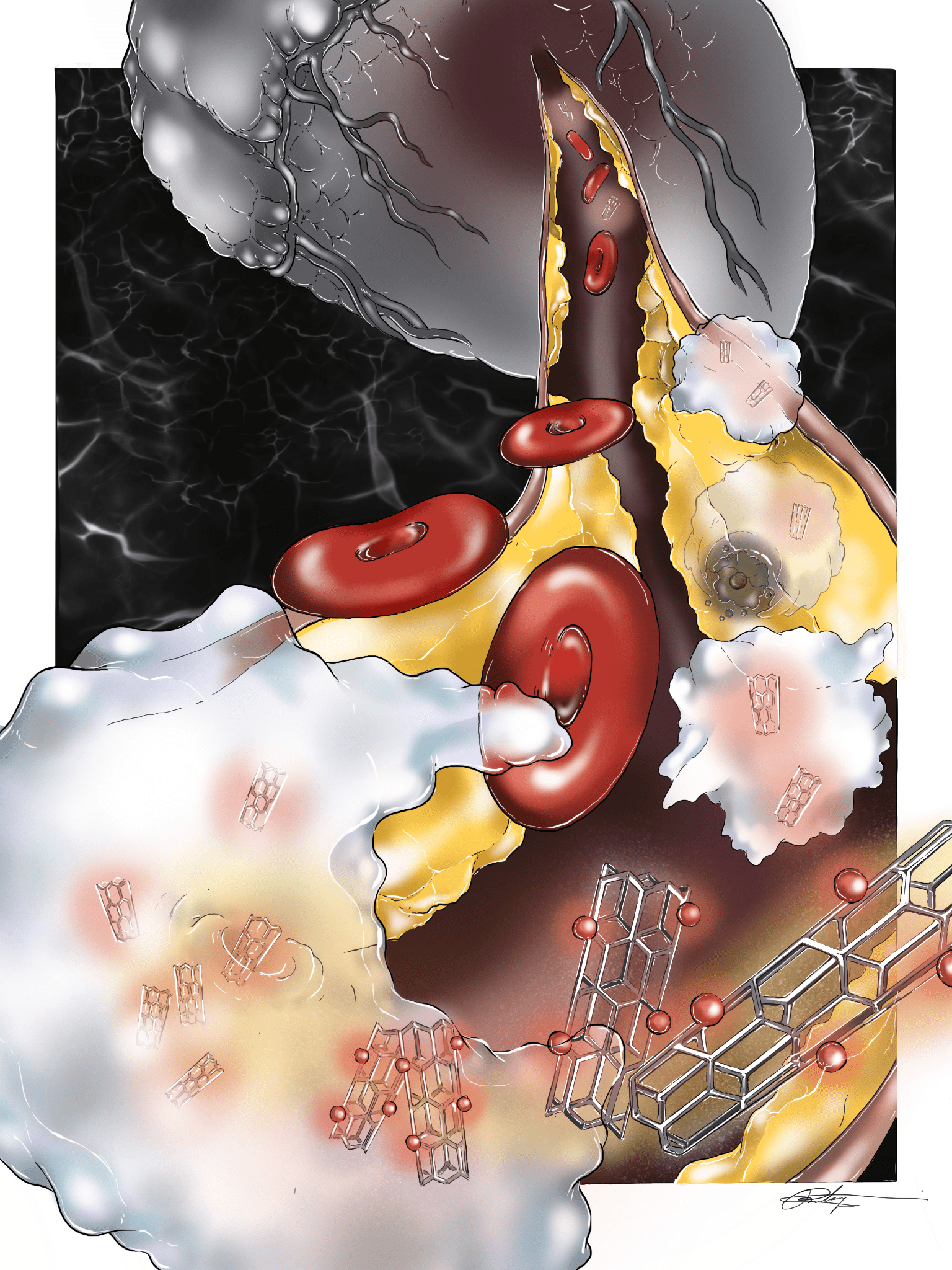 Biomedical engineer Bryan Smith is developing a nanoparticle to eat away portions of plaques causing heart attacks.