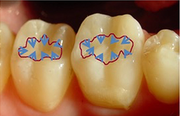 New materials are being developed at MSU to counter the stresses put on dental restorations.