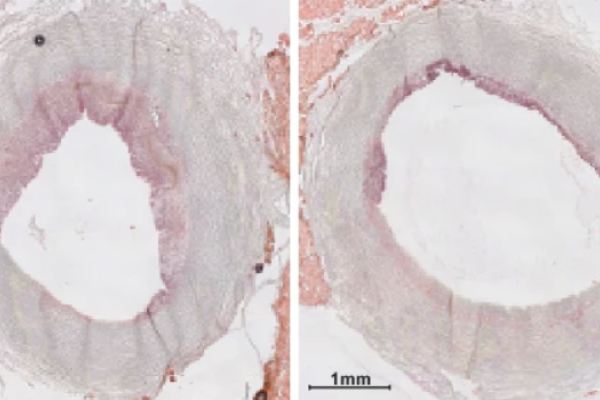 MSU research advances infusion designed to clean arteries