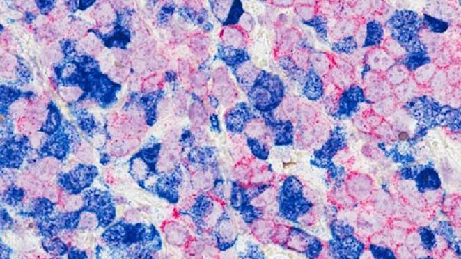 MSU researchers use ‘smart’ bomb therapy to destroy breast cancer
