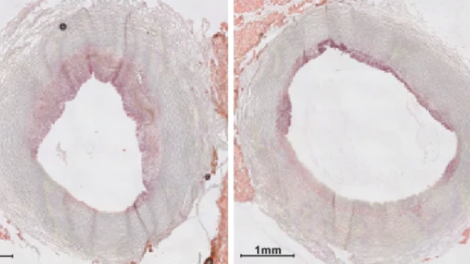 MSU research advances infusion designed to clean arteries